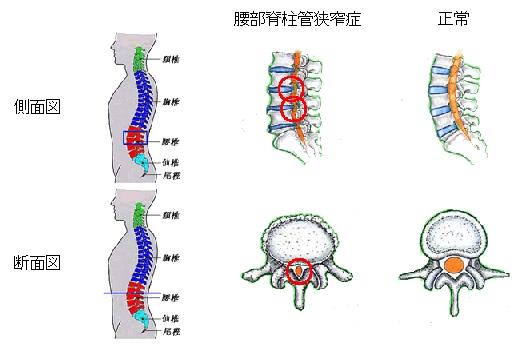 腰部脊柱管狭窄症の図式